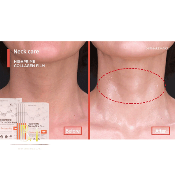 پچ کلاژن پنج عددی پیشانی یا گردن درماسنس DERMARSSANCE